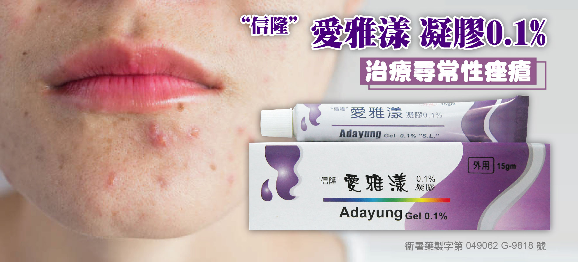 Adayung Gel 0.1% Adapalene